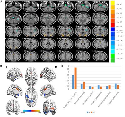 Abnormal percent amplitude of fluctuation changes in patients with monocular blindness: A resting-state functional magnetic resonance imaging study